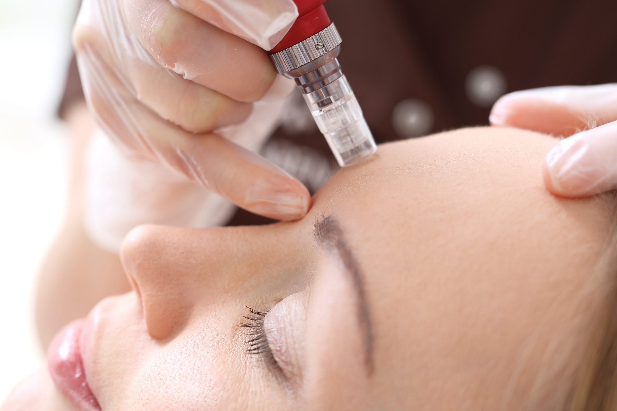 Microneedling 